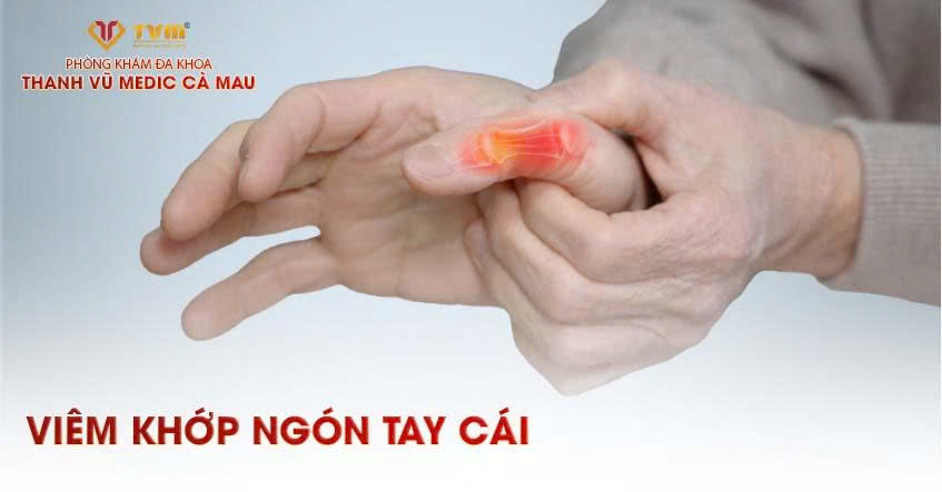 Viêm khớp ngón tay cái: Nguyên nhân, dấu hiệu và cách chữa trị